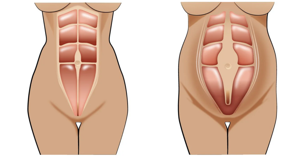 rappresentazione anatomica di diastasi addominale