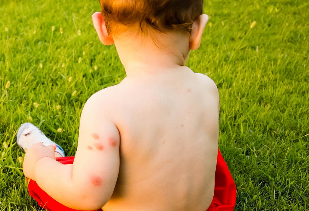 esempio di orticaria nei bambini