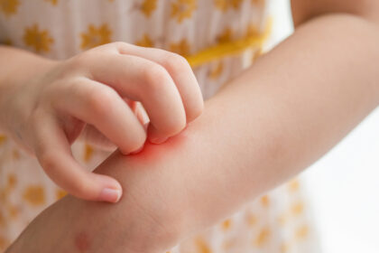 tutto sull'orticaria nei bambini riconoscerla e trattarla